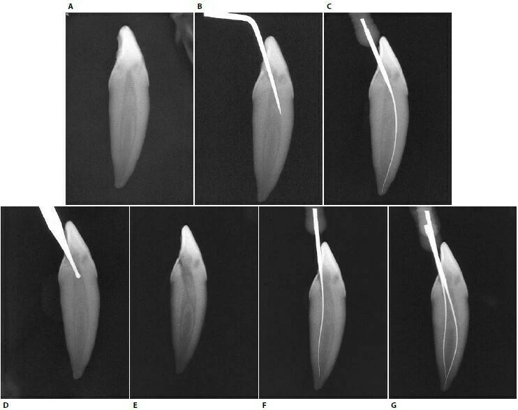hình ảnh x-quang chiều dài ông tủy
