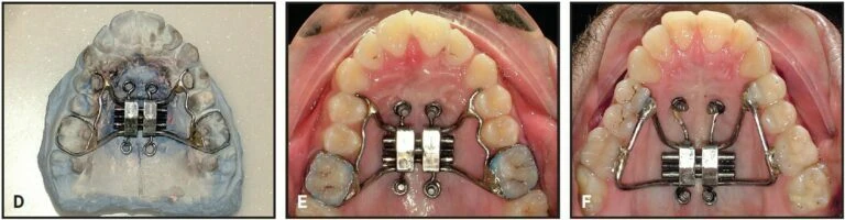 Chế tạo hàm nong nhanh hỗ trợ minivis: kỹ thuật đơn giản cho nha sĩ - D09698 cbe4a78967cb458ab893c11e909c943dmv2