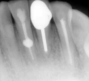 Phân biệt sự khác nhau giữa tổn thương nội tiêu và ngoại tiêu trên phim x-q - D09698 cfaa4fd168644622a6e54bbcdeecaa55mv2