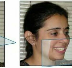 Phân loại sai khớp cắn (phần 3): các thay đổi phân loại sai khớp cắn angle – cơ bản - D09698 dd85f8405add4e81bf2f4c758fdfa...