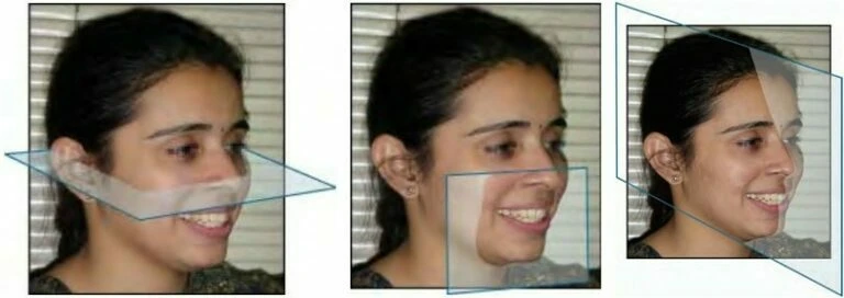 Phân loại sai khớp cắn (phần 3): các thay đổi phân loại sai khớp cắn angle – cơ bản - D09698 dd85f8405add4e81bf2f4c758fdfa...