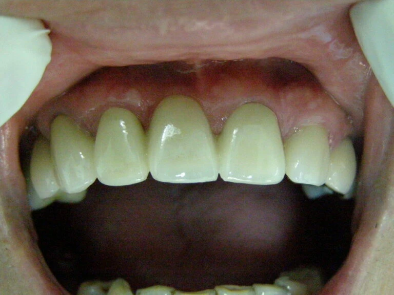 Bảo tồn nhú lợi trong phục hình thẩm mỹ - D09698 de13ad9b60b54d85a047df53f2e8c6femv2