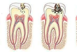 Bệnh lý tủy răng (phần 1) – nguyên nhân và triệu chứng - D09698 ff813d2af59647b99a4482f1216fbb4cmv2
