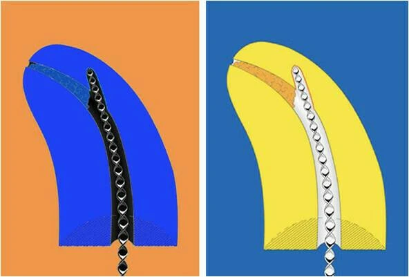 Sự dịch chuyển ống tủy trong điều trị nội nha