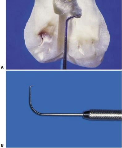 Cho phép lấy sạch buồng tủy