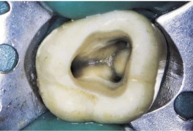 MỞ XOANG TỦY VÀ CẤU TRÚC GIẢI PHẪU TRONG NỘI NHA THẤY RÕ SÀN TỦY LỖ TỦY