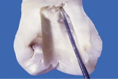 MỞ  RỘNG XOANG Ở THÀNH GẦN