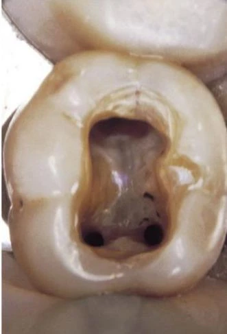 SẢN TỦY DỄ DÀNG ĐƯA VÀO ỐNG TỦY