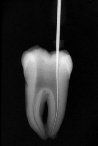 SỬA SOẠN ỐNG TỦY