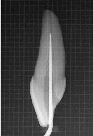MỞ XOANG TỦY VÀ CẤU TRÚC GIẢI PHẪU TRONG NỘI NHA SOANG TỦY THÀNH 1 ĐƯỜNG THẲNG