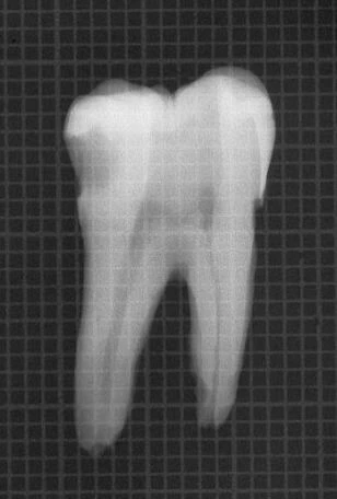 XOANG TỦY PHÂN KÌ