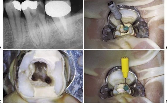 TẠO XOANG TỦY TƯƠNG ỨNG