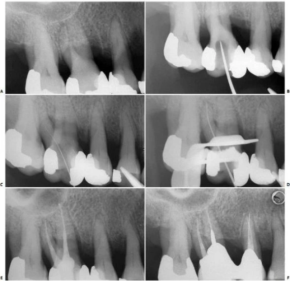 MỞ XOANG TỦY VÀ CẤU TRÚC GIẢI PHẪU TRONG NỘI NHA PHÂN RĂNG CỐI LỚN 1 HÀM TRÊN