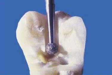 MỞ XOANG TỦY VÀ CẤU TRÚC GIẢI PHẪU TRONG NỘI NHA GIAI ĐOẠN XUYÊN QUA