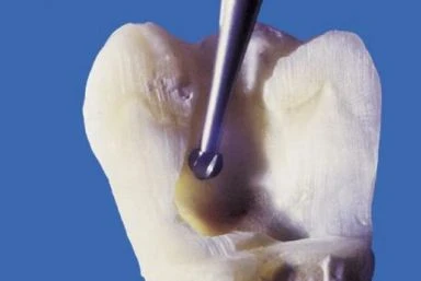 MŨI KHOAN CẮT PHẦN NGÀ