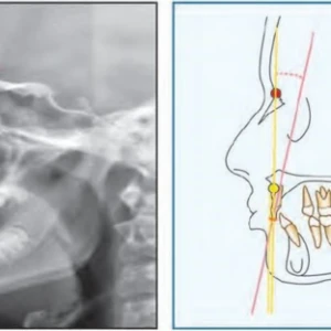Chỉnh nha ( phần 9) - phân tích Steiner - 13 file