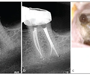 Điều trị nội nha: tạo hình ống tủy cong và xử lý canals phụ - 173 file