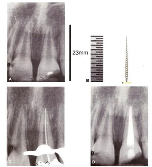 Quyết định chiều dài làm việc trong điều trị nội nha