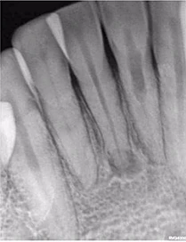 Phim XQ 2 chiều trước điều trị