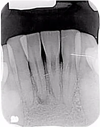 XQ 2 chiều trước điều trị (ảnh chụp ở phòng khám khác