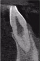 Vì sao tôi yêu CBCT - Hay chia sẻ việc ứng dụng CBCT trong thực hành nha khoa Lát cắt đứng dọc trên CBCT