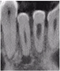 Vì sao tôi yêu CBCT - Hay chia sẻ việc ứng dụng CBCT trong thực hành nha khoa Lát cắt đứng ngang trên CBCT 