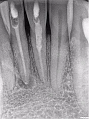 Đặt thuốc Ca(OH)2