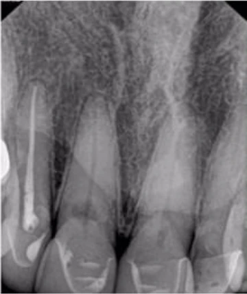 Vì sao tôi yêu CBCT - Hay chia sẻ việc ứng dụng CBCT trong thực hành nha khoa XQ trước điều trị