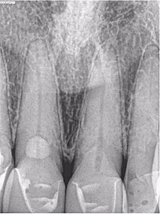 Ảnh trước điều trị tủy, sau khi đã xử lý tổn ngoại tiêu