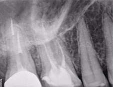 Vì sao tôi yêu CBCT - Hay chia sẻ việc ứng dụng CBCT trong thực hành nha khoa CÂN CHÓP SỐ 3