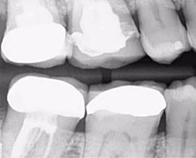Vì sao tôi yêu CBCT - Hay chia sẻ việc ứng dụng CBCT trong thực hành nha khoa
