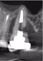Vì sao tôi yêu CBCT - Hay chia sẻ việc ứng dụng CBCT trong thực hành nha khoa LÁT CẮT NGANG CBCT