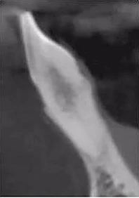 Vì sao tôi yêu CBCT - Hay chia sẻ việc ứng dụng CBCT trong thực hành nha khoa LÁT CẮT NGANG 31