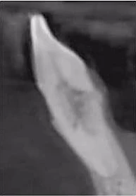 Vì sao tôi yêu CBCT - Hay chia sẻ việc ứng dụng CBCT trong thực hành nha khoa LÁT CẮT NGANG 41