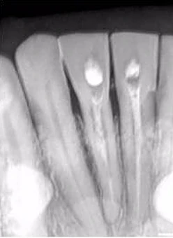 Vì sao tôi yêu CBCT - Hay chia sẻ việc ứng dụng CBCT trong thực hành nha khoa HAI RĂNG DC CẮT CA(OH)2