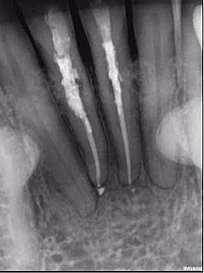 Vì sao tôi yêu CBCT - Hay chia sẻ việc ứng dụng CBCT trong thực hành nha khoa ẢNH SAU ĐIÈU TRỊ