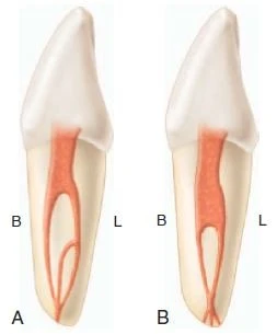 hình thể ống tủy của Kartal và Yanikoglu. B, Mặt ngoài; L, Mặt trong.