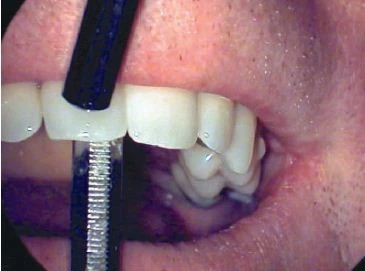 Khám ( phần 2): đường dò trong miệng - 4 file