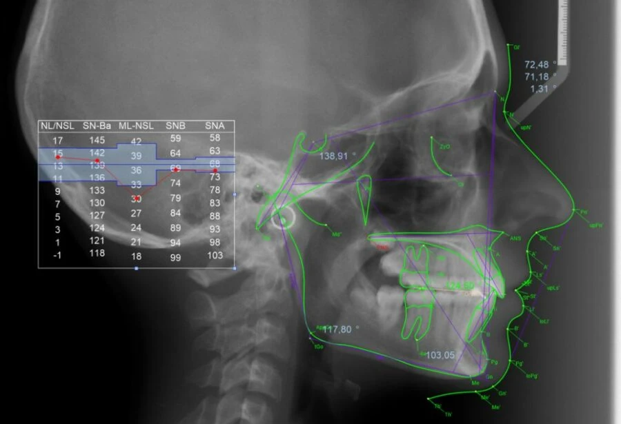 PHÂN TÍCH CEPHALOMETRIC
