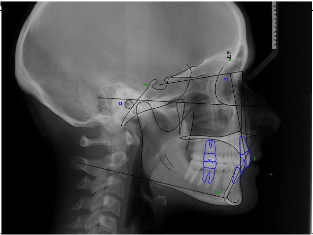 Phân tích phim Cephalometric ( Phần 2)