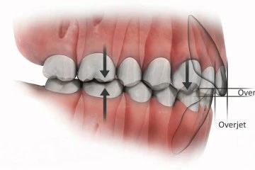 tương quan trong chỉnh nha
