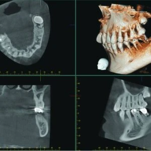 Cone BEAM computed Tomography in oral surgery - 0bf219 f19f8175dde9467c9ae4a10a183eedc8mv2