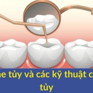 che tủy và kĩ thuật che tủy