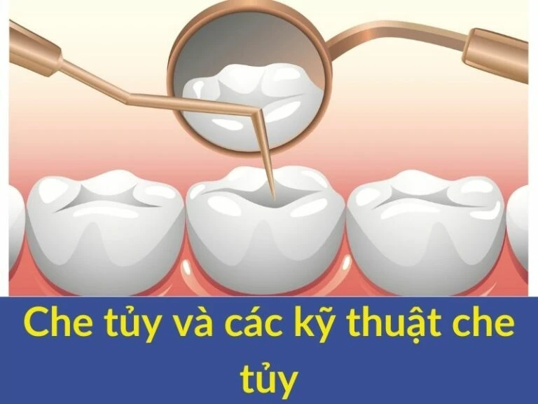che tủy và kĩ thuật che tủy