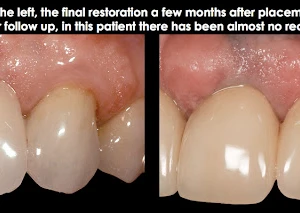 Xử lý đường hoàn tất dưới nướu ở bệnh nhân - 67 file