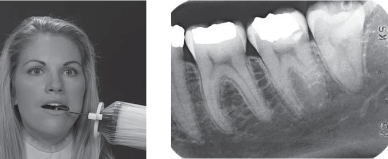 X-quang nha khoa (phần 18) – đọc phim
