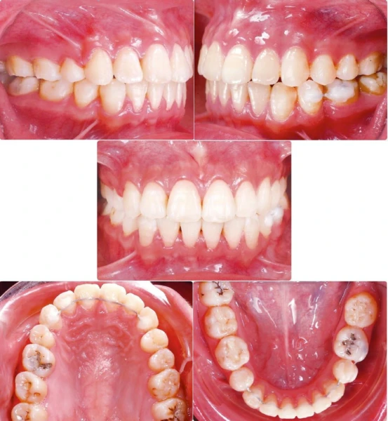 anh-chup-trong-mieng-sau-dieu-tri