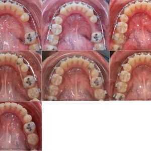 Sửa chữa vẩu hai hàm và đóng khoảng nhổ răng hàm nhỏ - kết quả - 8 file