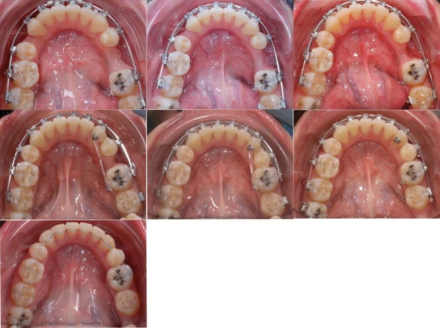 Sửa chữa vẩu hai hàm và đóng khoảng nhổ răng hàm nhỏ - kết quả - 8 file