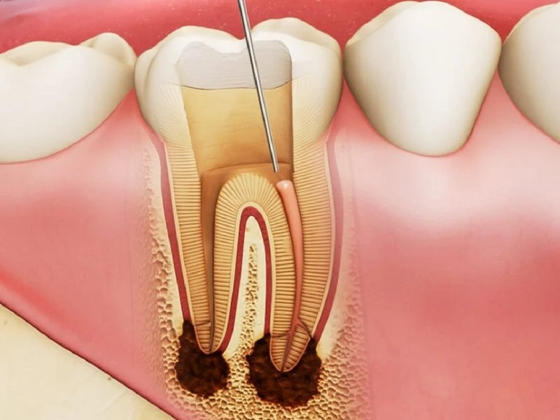 laser-trong-noi-nha-phan-ii-1